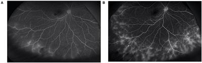 The Efficacy and Safety of Adalimumab in Treating Pediatric Noninfectious Chronic Anterior Uveitis With Peripheral Retinal Vascular Leakage: A Pilot Study